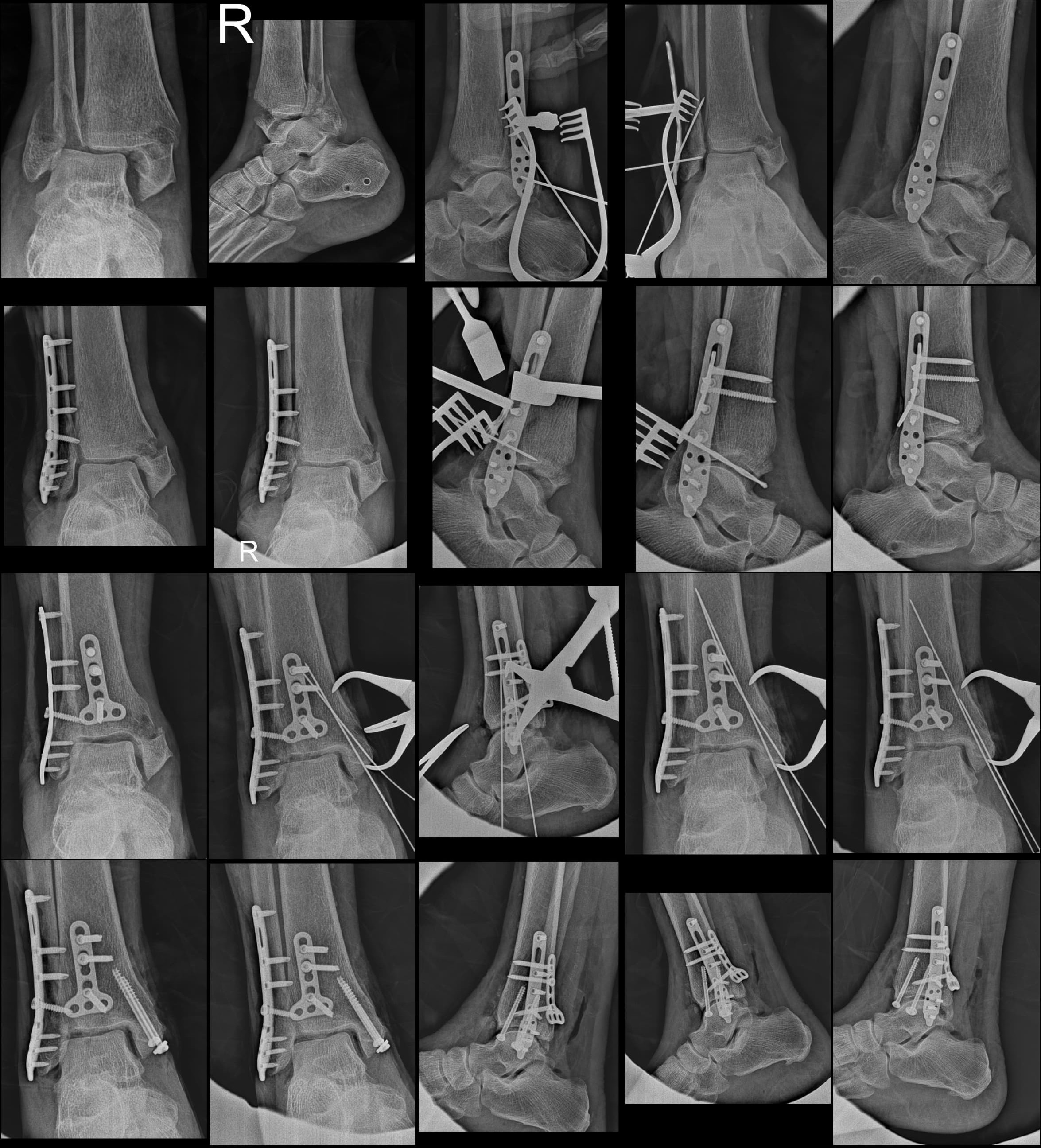 Fracture Treatment