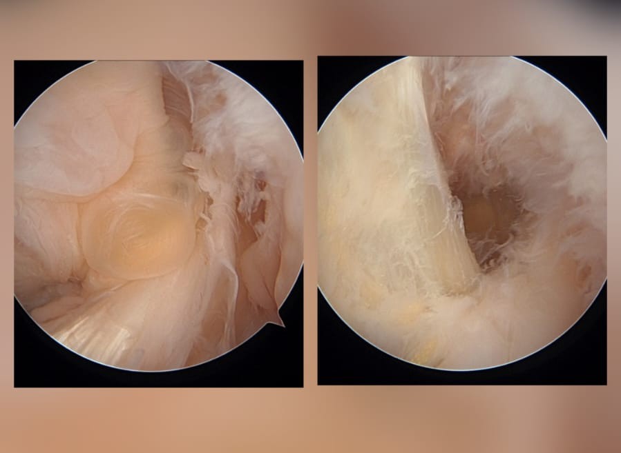 Knee Arthroscopy